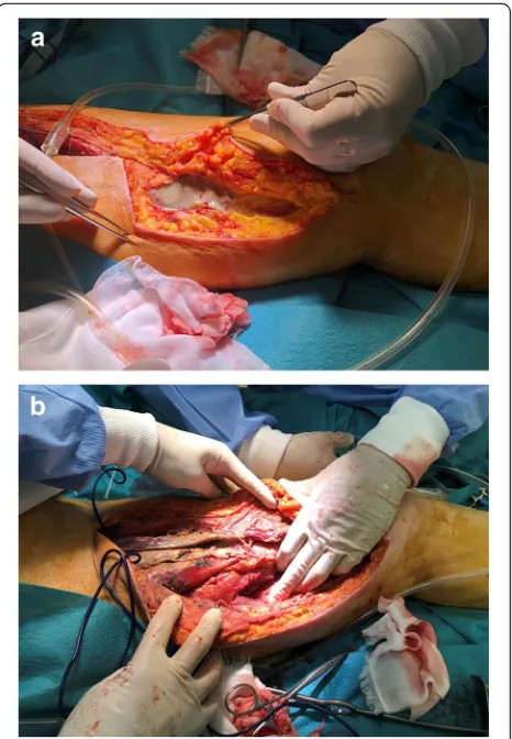 Fig. 3 a, b Additional extensive open wound for drainage from theinitial drainage site of the left thigh (Fig