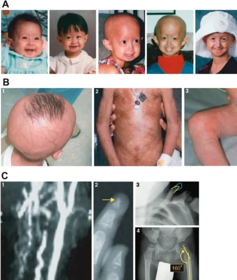 FIGURE 1Physical characteristics of progeria with age. A, A girl with progeria at ages 3 months, 13 months, 3 years 11 months, 6 years 6 months, and 9 years