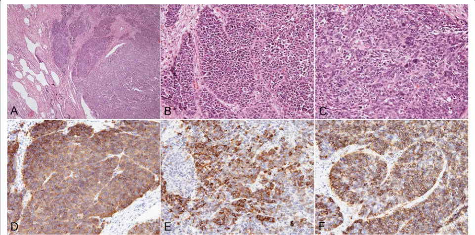 Fig. 4 Histopathologic findings. Atypical cell nests with large nuclei are seen with lung invasion (a)