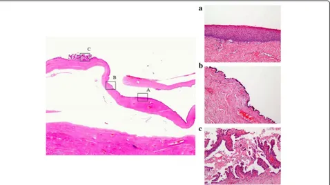 Fig. 6 The left fimbria of the fallopian tube had a lymphovascular space of invasion of calcifying carcinoma cells