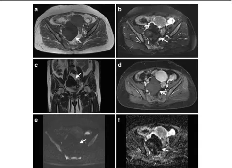 Fig. 1 A 47-year-old women with a fibroma on the right ovary(arrows). Axial T1-weighted image (a) shows an oval mass of low signal intensity.Axial T2-weighted with fat suppression image (b) and coronal T2-weighted image (c) shows the mass was homogenous lo