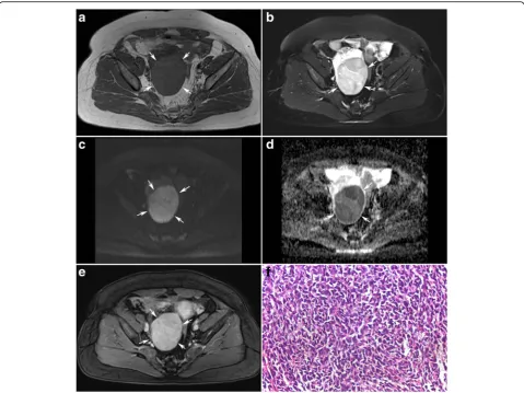Fig. 5 Boxplot of the ADC value of sex cord-stromal tumor of theovary. ADC value of solid component was significantly lower inmalignant SCSTs (0.825 ± 0.129 × 10− 3 mm2/s) than in benign SCSTs(1.343 ± 0.528 × 10− 3 mm2/s) when fibromas were excluded