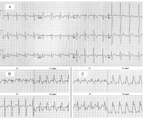 FIGURE 2A, A 12-lead ECG, which is clearly abnormal, taken from our patient the day after the ventricular tachycardia