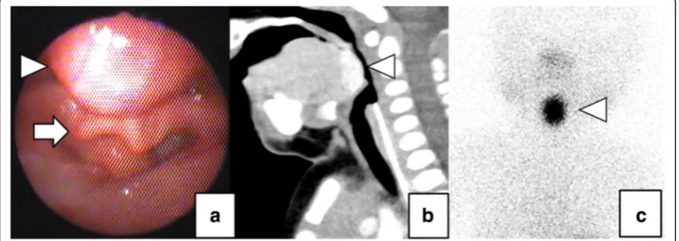 Fig. 1 Preoperative imaging tests. Laryngeal endoscopy revealed a lingual mass (arrow head) compressing the epiglottis (arrow) ((a)