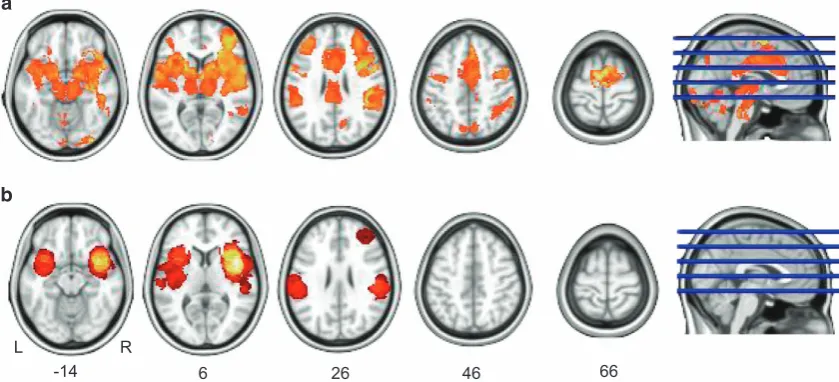 Figure 6. One-sample meta-analysis of 21 studies investigating the effect of pain.uncorrected) for the image-based ( Areas of signiﬁcantactivation with an FWE-corrected cluster-wise threshold Po0.05 (cluster-forming threshold Po0.001a) and the coordinate-based (b) meta-analyses.