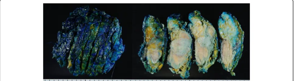Fig. 3 Magnetic resonance imaging. a A 4.5-cm-diameter mass at the upper outer portion of the right breast