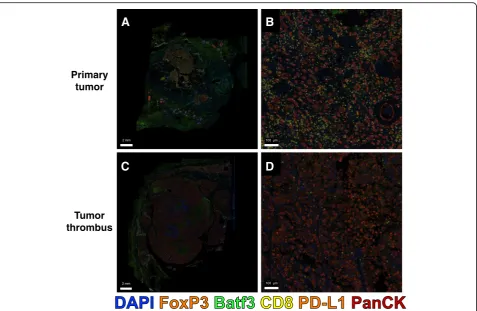 Fig. 3 Multichannel immunofluorescence of renal mass and tumor thrombus. Representative images of residual tumor in the segmental renalvein that responded to therapy at low power (a) and high power (b) with clusters of co-localized CD8+ T cells and Batf3+ 