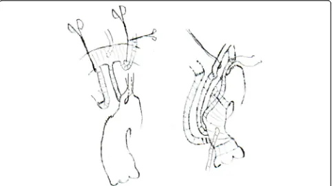 Fig. 1 Showed how to dissect and expose the left subclavain artery in deep position. Left common carotid artery could be slung aside aftertransecting at the boot of the artery