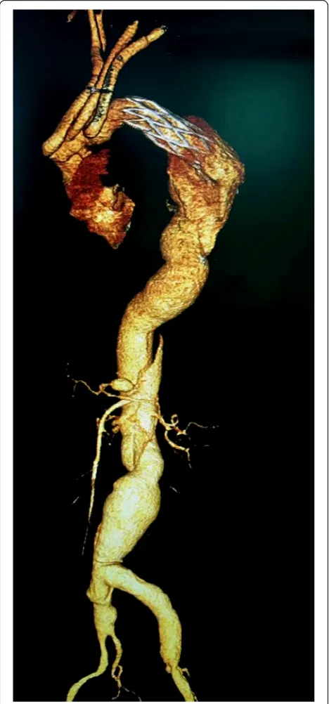 Fig. 2 Showed a graft with a stented elephant trunk deployedantegradely into the false lumen of aortic dissection during circulationarrest