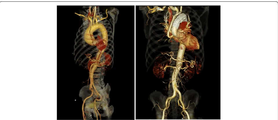 Fig. 3 Showed the imaging of our modified procedure preoperatively and postoperatively, the stent graft was deployed retrogradely under theconfirmation by angiography