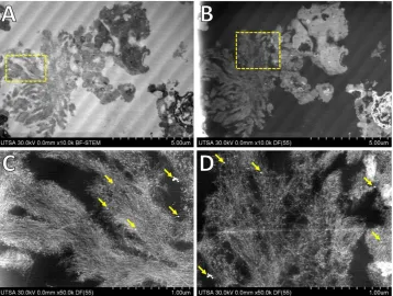 Figure 2. Imaging of ultra-thin sections of amyloid cores from AD. (A) Low voltage BF-STEM revealed the ultra-structure and arrangements of amyloid fibers