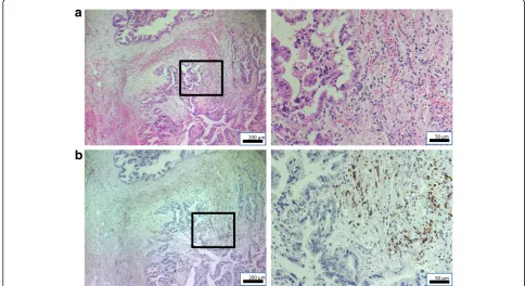 Fig. 1 Representative hematoxylinSpecimen with tumor-infiltrating lymphocytes. Right: × 200; left (insert): × 50.–eosin-stained images and CD3+ immunohistochemistry results in primary gallbladder cancer specimen