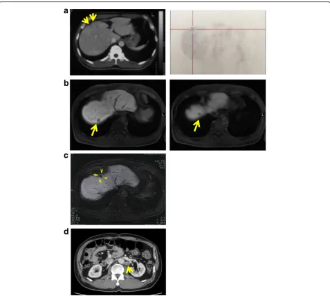 Fig. 3 Image diagnosis. a Left: positron emission tomography-computed tomography (PET-CT) findings at 3 months after surgery shows poor contrastenhancement area in S5 (arrows)