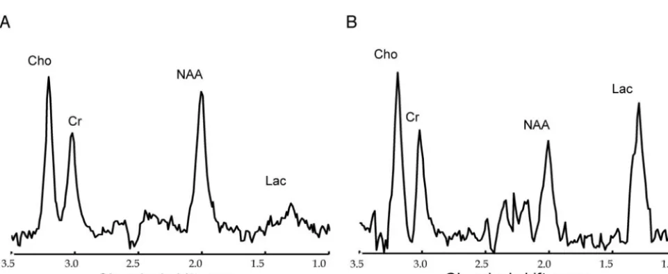 FIGURE 2Representative 1H spectra from an infant with normal outcome (A) and an infant with severely abnormal outcome (B)