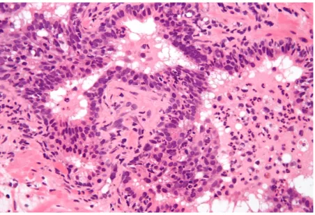 Figure 1.2: Acute prostatitis (source: Wikimedia commons) 