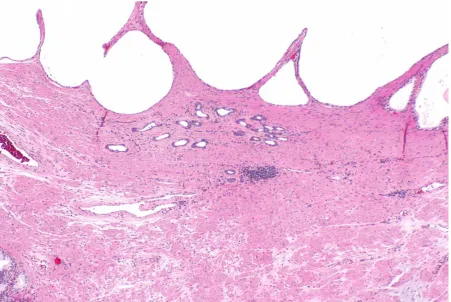 Figure 1.3: Simple atrophy (centre) and simple atrophy with cyst formation (top) (source: 
