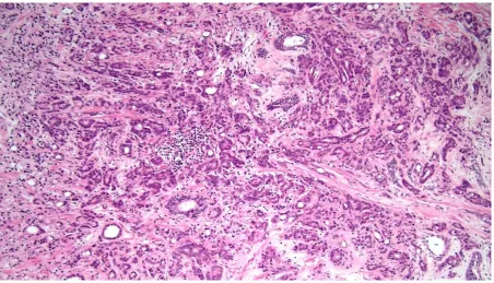 Figure 3.14: Grade 0 tumour chronic inflammation(H&E, 20x) 