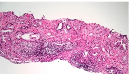 Figure 3.16: Grade 2 tumour chronic inflammation (H&E, 10x) 