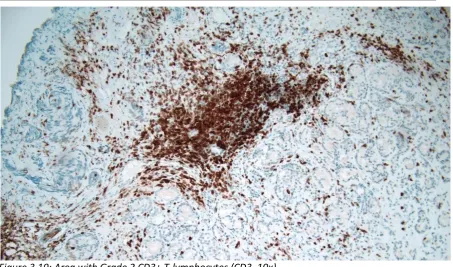 Figure 3.19: Area with Grade 2 CD3+ T-lymphocytes (CD3, 10x)