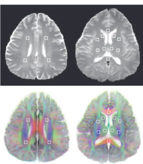 TABLE 2Mean Regional Trs and FAs in Brain of Normal Control and PWS Patients