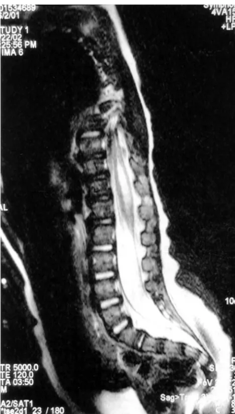 FIGURE 1The microdeletion region contains 28 genes, of which 4 areSagittal T2-weighted MRI of the thoracolumbar spine revealed a syrinx cavity extendinghighly expressed in the brain.15,17 Thus far, only 2 genesfrom T10 to L2