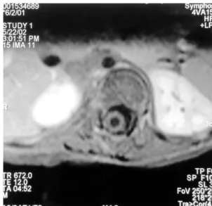 FIGURE 2Sagittal T2-weighted MRI of the thoracolumbar spine revealed a