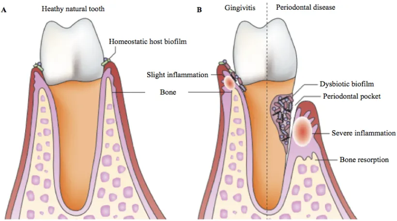 Figure 1.1 Progression from periodontal health to gingivitis and eventually 