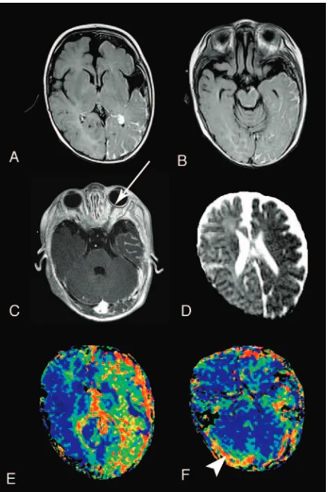 FIGURE 3MRIscansofa4-month-oldinfantwithSWS.AandB,AxialFLAIRimagesafterintravenousgadolinium chelate showing avid leptomeningeal enhancement in the temporal, pari-etal, and occipital regions