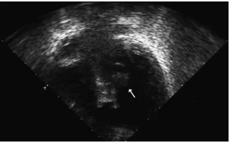 FIGURE 1Shortened apical 2-dimensional 4-chamber–view echocardiography showing the VSDAmplatzer device and, on the left ventricular side, a large pedunculated vegetation(white arrow) on the superior aspect of the disk.