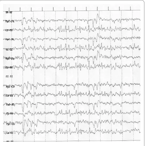 Figure 2 Trisomy 13: Generalized seizures - Centro-temporal-frontal spikes and waves.