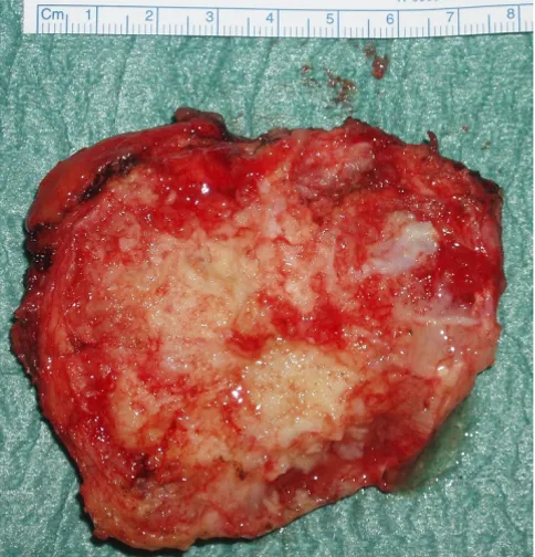 Figure 5areascostochondral surface interspersed with cystic and solid The excised tumour mass showing its irregular variegated The excised tumour mass showing its irregular varie-gated costochondral surface interspersed with cystic and solid areas.