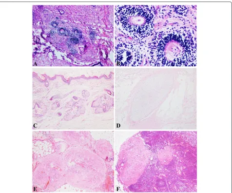 Fig. 2 Immature neuroepithelial tissue in the form of neuroectodermal rosettes are admixed with mature tissuescartilageperitoneumneuroectodermal tissue a HE stain × 40