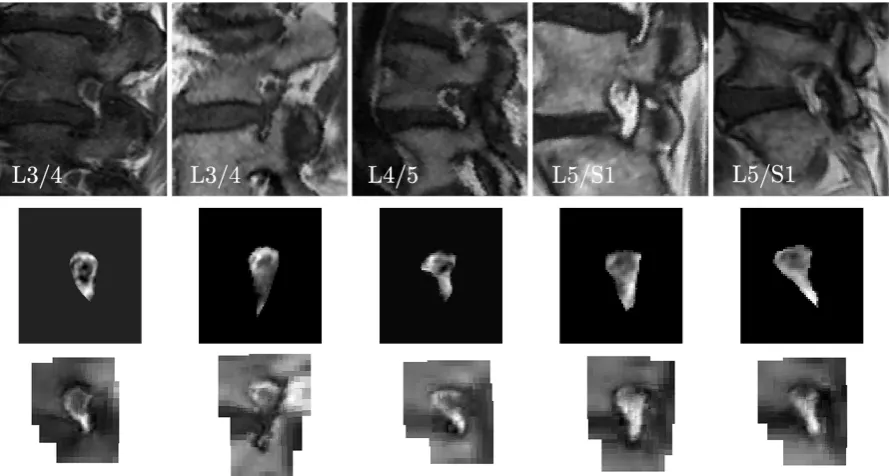 Figure 13: Fitting and reconstruction results of neural foramen on ﬁve cases. Top: Testingdata; Middle: Reconstructed appearance by AAMs; Bottom: Reconstructed appearanceby AAPs.