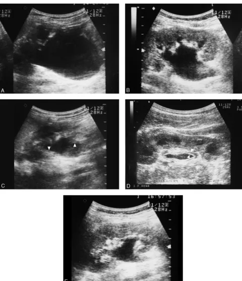FIGURE 2Serial ultrasound ﬁndings from the acute episode through to recovery. A, This 8-year-old boy had severe hydronephrosis at the painful stage