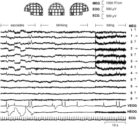Figure 11: (From Vigário et al, 1998). Samples of MEG signals, showing artifacts produced by blinking, saccades, biting and cardiac cycle