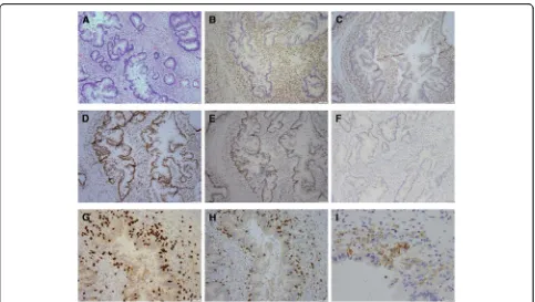 Fig. 2 Immune Profiling of Metastatic Lesion. Metastatic pancreatic adenocarcinoma showing loss of MLH1 and PMS2 and increased immune cellinfiltration