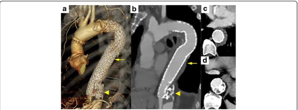 Fig. 3 a Postoperative 3D–CTA imaging 1 year after TEVAR with implantation of a ‘candy-plug’