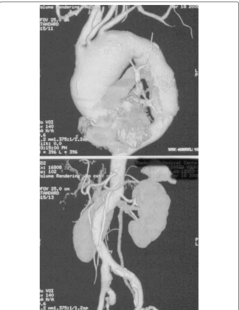 Figure 1 3DCT scan obtained on admission, showing extensive thoracic aortic aneurysms.
