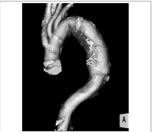 Figure 2 After total aortic arch replacement with an elephant trunk procedure.