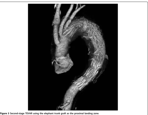 Figure 3 Second-stage TEVAR using the elephant trunk graft as the proximal landing zone.