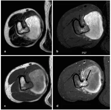 Fig. 3 Coronal magnetic resonance imaging (MRI) T1 turbo spinecho (TSE) (a), MR angiography (b), and digital angiography (c)
