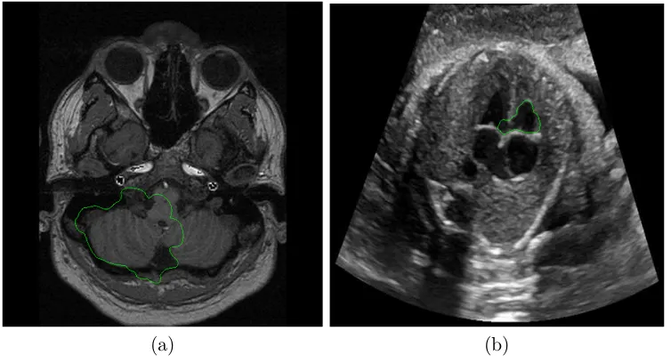 Figure 3.1: Example of medical image segmentation with weak edges and usingGVF active contour