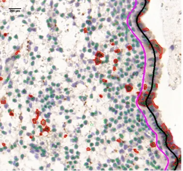Figure 4.8: Final results of the stromal cell detection, UNK cell nucleus regionsegmentation, and luminal epithelium edge localisation on a sample image