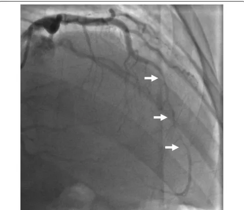 Figure 1 Angiographic view showing LAD dissection 67 days post-partum involving the mid vessel (arrows)