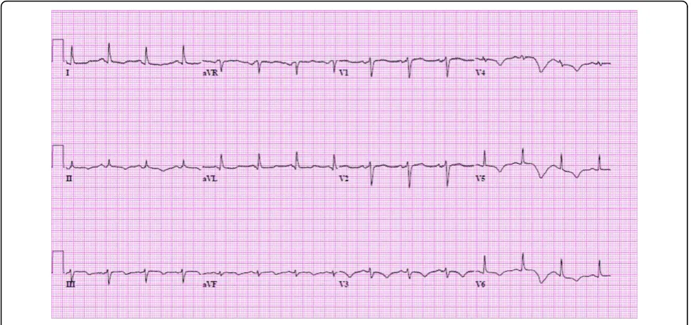 Figure 4 The EKG demonstrates new T wave inversion in the lateral leads.