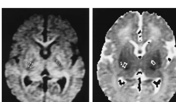 Fig 1. Placement of regions of interest over the PLIC on a DWI (left). These regions of interest were then overlaid onto an ADC map (right)to measure ADC values in the PLIC using Functool (GEMS).