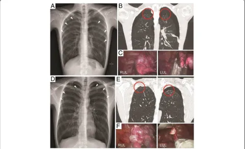 Fig. 1 a, d Chest x-ray shows bilateral spontaneous pneumothorax of case 1 and 2 (white arrow head)