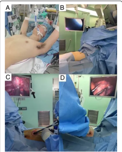 Fig. 2 a Patient positioning for bilateral, staged-operation. In asupine position, both arms were hung to the overhead strut of theether screen using arm slings, and a cushion was packed below theback for chest elevation