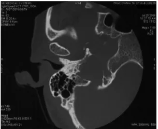 Figure 2.   CT, axial image, bone window, shows osteosclerotic changes  of the right petrous pyramid.