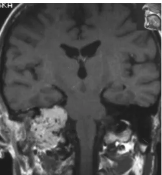 Figure 5.   Carotid angiography, lateral view. Typical picture of  hypervascular tumors in a patient with three synchronous  paragangliomas on one side of the head and neck: jugular  bulb paraganglioma, vagal paraganglioma and carotid  body tumor.